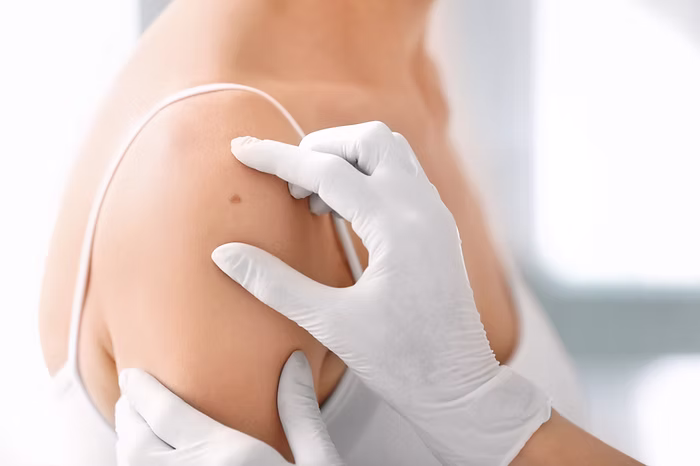 Why Are Regular Skin Checks Essential for Detecting Skin Cancer Early?